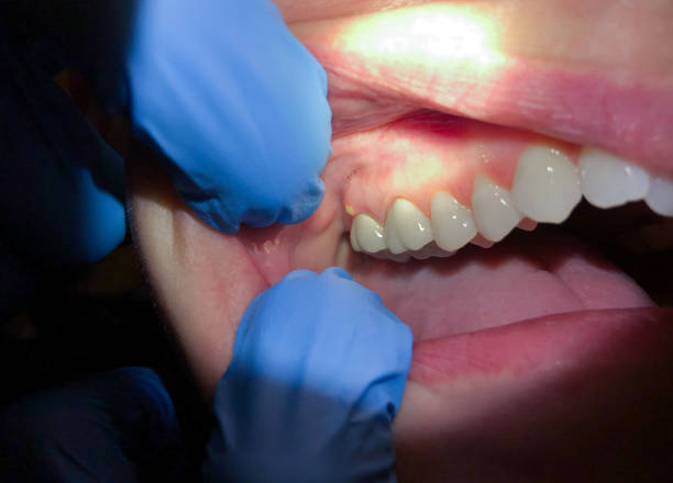 Best Emergency Tooth Extraction in Lone Grove, OK